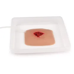 Wundmoulage wound packing einer großen Wunde
