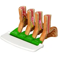 4-teilig mit GERD- (Gastroösophageale Refluxkrankheit)