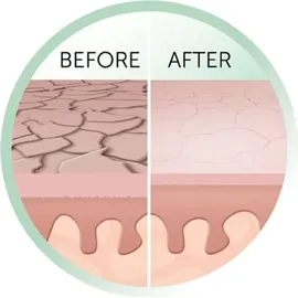 Remington Reveal MD3000 Mikrodermabrasion