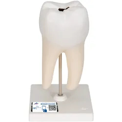 Zahn Modell Unterer Zweiwurzeliger Molar mit Karies, 2-teilig - 3B Smart Anatomy