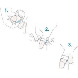 KESSEL medintim GmbH Prosecca Band Harnröhrenverschlussbändchen