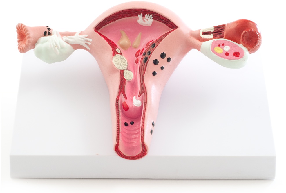 Gebärmuttermodell mit Erkrankungen Uterus-Modell HeineScientific