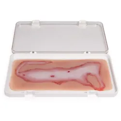 Wundmoulage großflächige Verbrühung