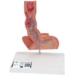 Pathologisches Modell der Speiseröhre - 3B Smart Anatomy