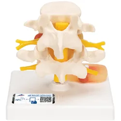 Lendenwirbelmodell mit Bandscheibenvorfall - 3B Smart Anatomy