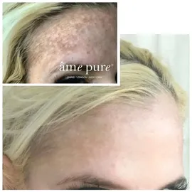 √¢me pure âme pure Basic Kit Micro Needle Roller Damen