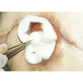 Urgo Medical Alginatwundauflagen 5 x 5 cm