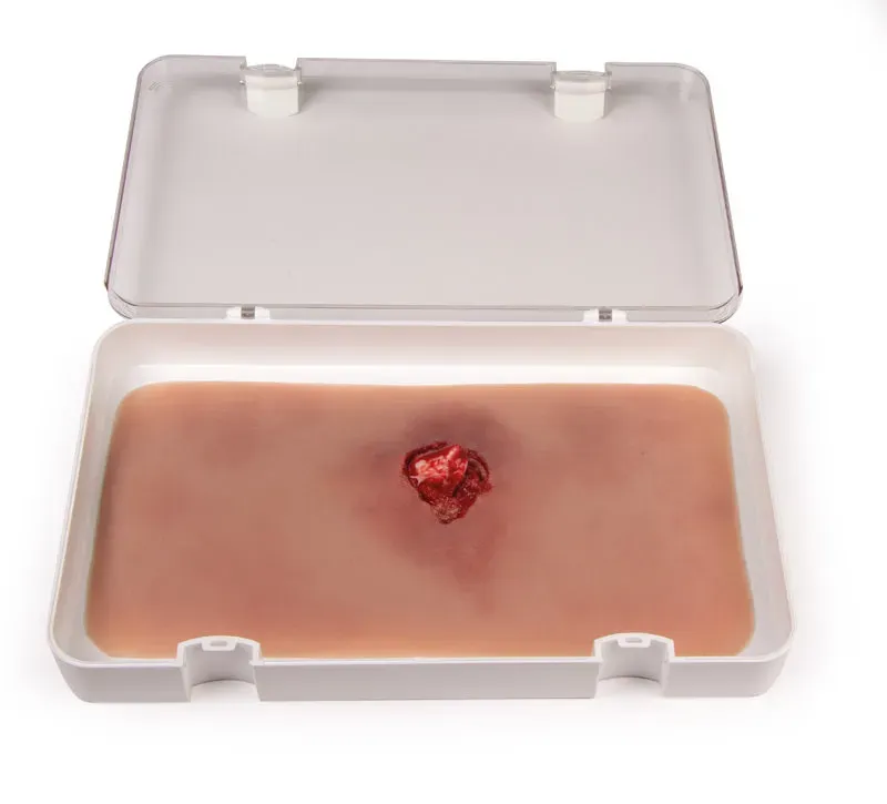 Offener Bruch Armextremtätenknochen mit Blutungsfunktion