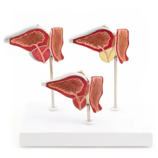 Anatomisches Prostata-Modell mit Erkrankungen 3-teilig HeineScientific