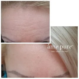 Âme Pure Basic Kit Micro Needle Roller Damen