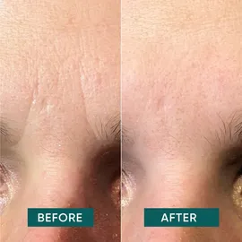 Apricot Gesicht Patches mit Niacinamid