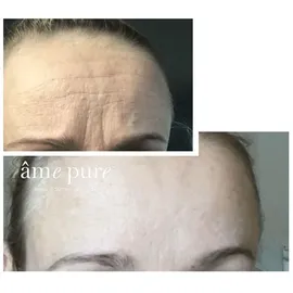 Âme Pure Basic Kit Micro Needle Roller Damen