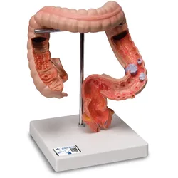 Pathologisches Darmmodell (Dick- und Enddarm) - 3B Smart Anatomy