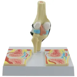 Kniegelenk-Modell Rheumatisch Knie-Modell Rheuma HeineScientific
