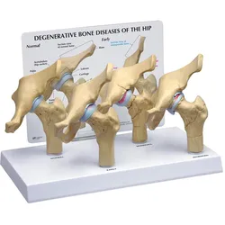 Degenerative Knochenerkrankungen des Hüftmodells in 4 Stadien