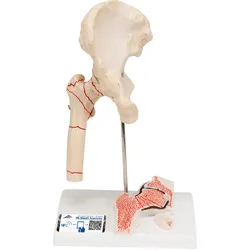 Hüftgelenkmodell mit Oberschenkelbruch & Hüftgelenkverschleiß - 3B Smart Anatomy