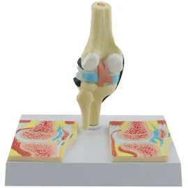 HEINESCIENTIFIC Kniegelenk-Modell Rheumatisch Knie-Modell Rheuma HeineScientific