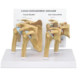 Osteoarthritis (OA) Schultermodell in 4 Stadien