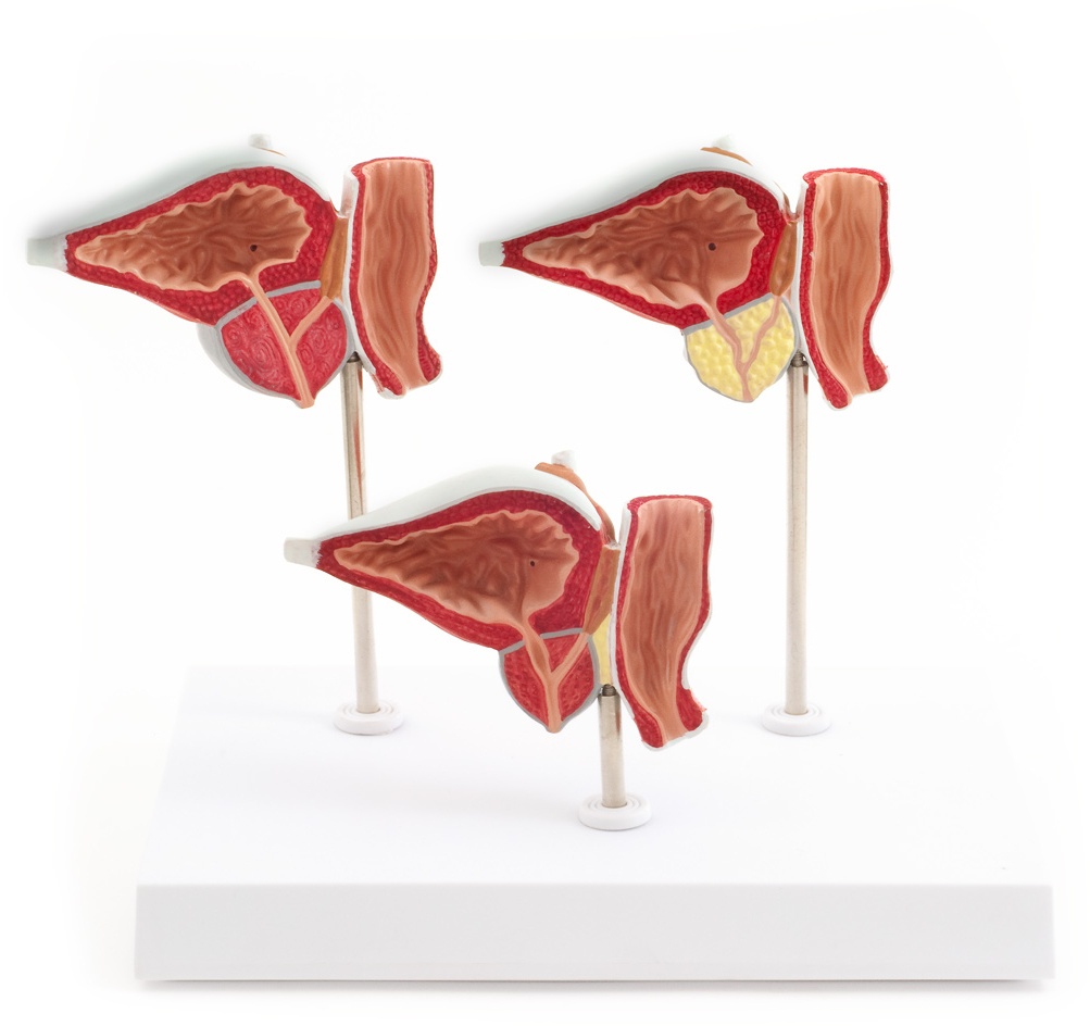 Anatomisches Prostata-Modell mit Erkrankungen 3-teilig HeineScientific