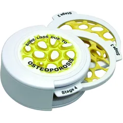 Knochenkrebs­Scheibenset - 4 Stadien der Osteoporose
