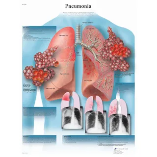 3B Scientific Humananatomie – Lungenentzündung, laminierte Version
