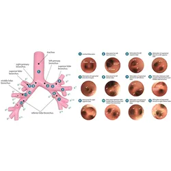 Bronchialbaum Bronchofiberskopie für Simulator schwieriges Atemwegsmanagement
