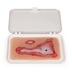 Wundmoulage Verbrühung der Haut