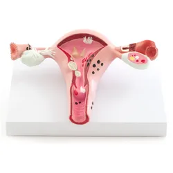 Gebärmuttermodell mit Erkrankungen Uterus-Modell HeineScientific