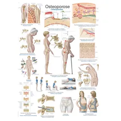 Lehrtafel Osteoporose 70x100cm