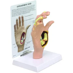 Modell einer Hand mit Osteoarthritis