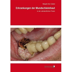 Erkrankungen Der Mundschleimhaut - Margrit-Ann Geibel  Kartoniert (TB)