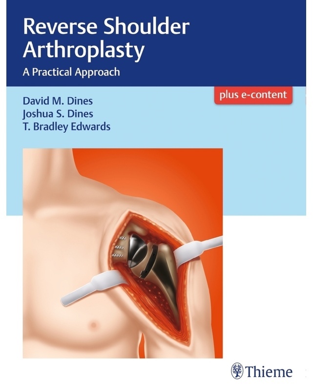 Reverse Shoulder Arthroplasty - David M. Dines  Joshua Dines  T Bradley Edwards  Gebunden