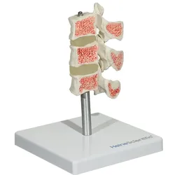 HEINESCIENTIFIC Osteoporose Modell 1 Stück